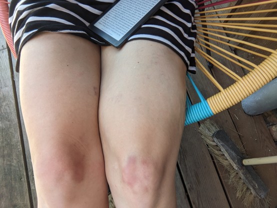 Close up of woman's bruised knees. She is wearing a black and white striped dress