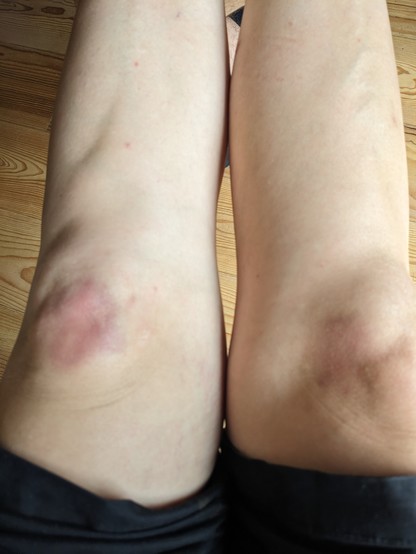 A close up of two bruised knees